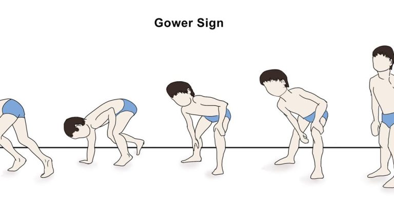gower's sign (gower sign)