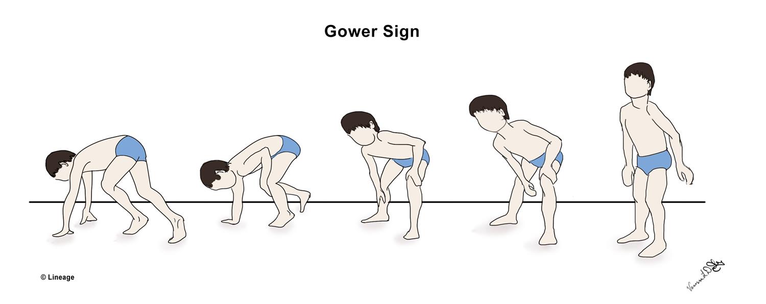 gower's sign (gower sign)
