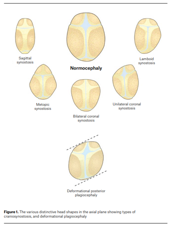 different types of synostosis