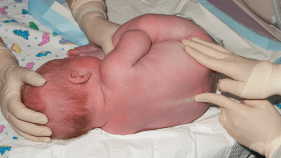 LP in neonate site and position