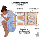 lumbar puncture