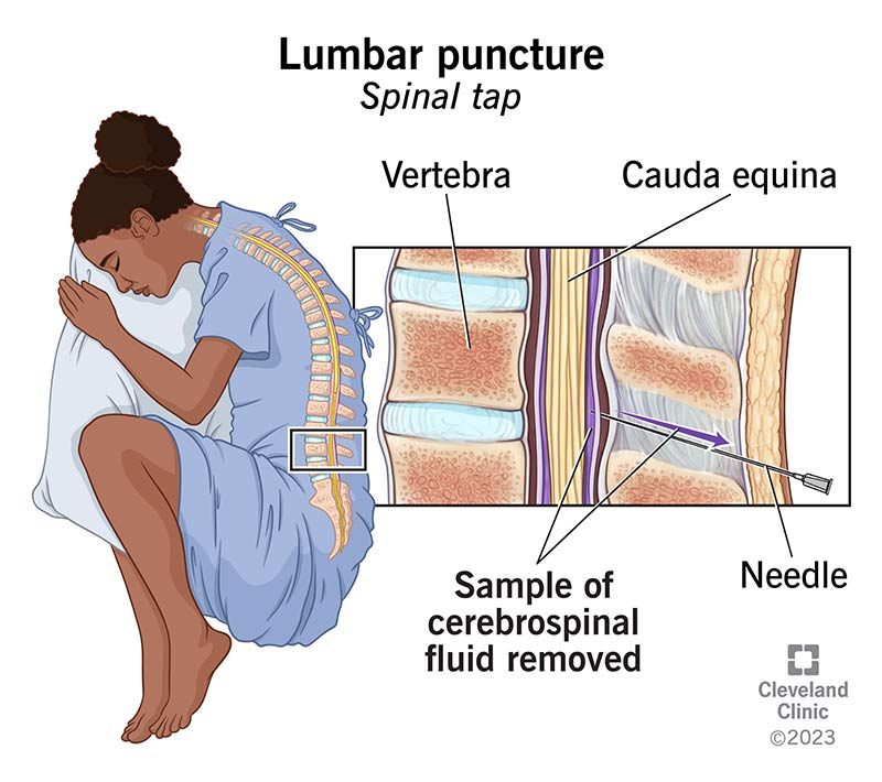 lumbar puncture