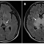 JE CT findings
