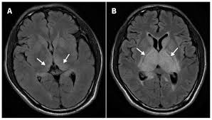 JE CT findings
