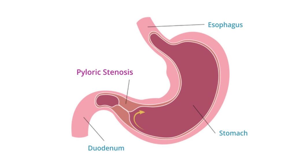 hypertropic pyloric stenosis