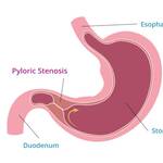 hypertropic pyloric stenosis