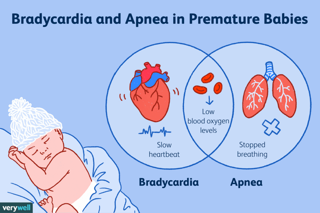 Apnoea of prematurity