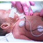 Bleeding in nepnates and inceased pt and inr in neonates