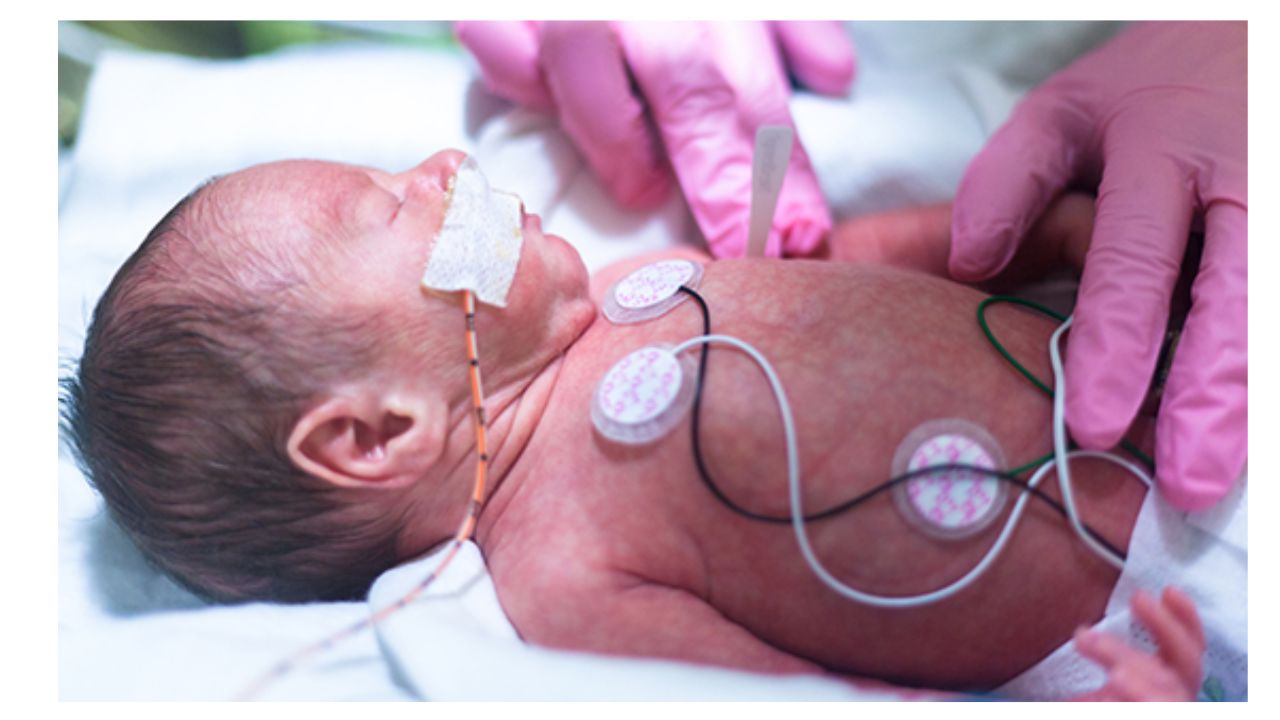 Bleeding in nepnates and inceased pt and inr in neonates