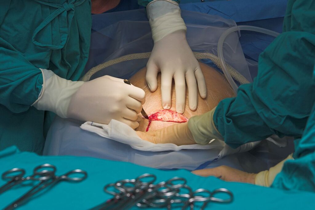 cesarean section