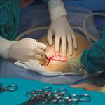 cesarean section