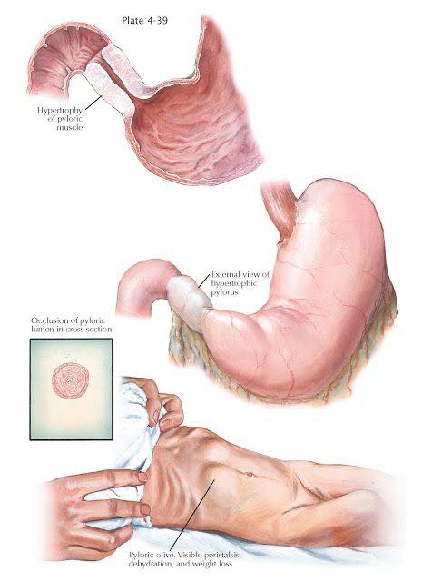 pyloric stenosis