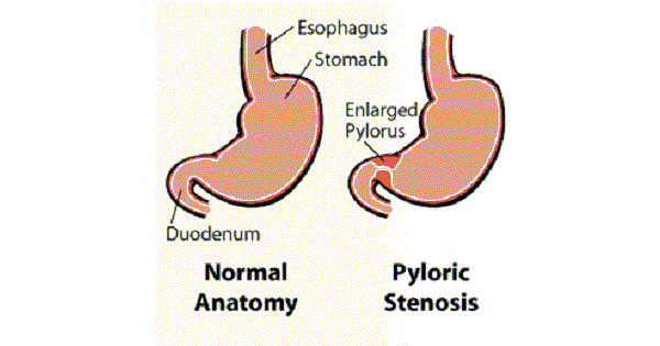 hypertrophic pyloric stenosis