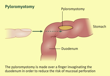 pyloromyotomy