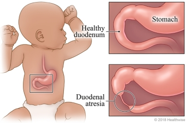 duodenal atresia