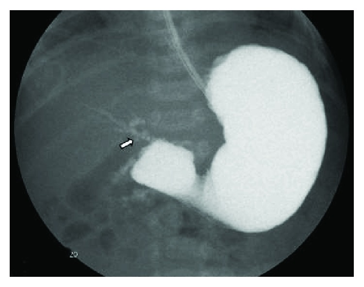 barium study of duodenal atresia