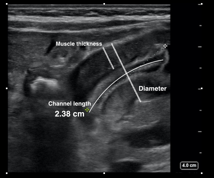 USG pyloric stenosis