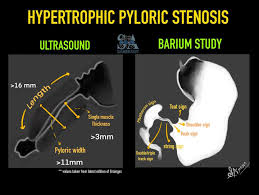 barium study vs USG in hypertrophic pyloris stenosis
