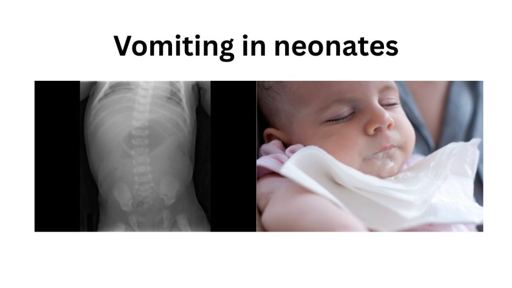 vomiting in neonates